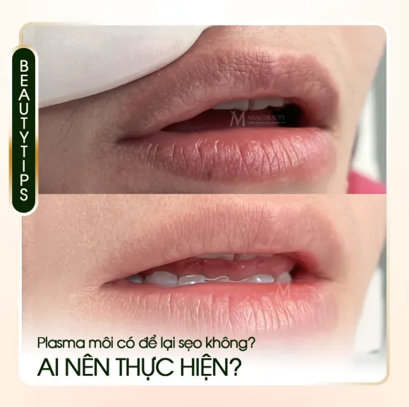 Bắn Plasma môi có để lại sẹo không? Ai là người nên thực hiện?