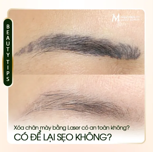Chân mày từng xóa laser làm lại có đẹp không? Chuyên gia Măng Beauty giải đáp từ A-Z