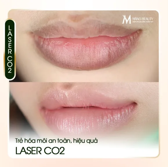 Laser Co2 - Giải pháp trẻ hóa môi an toàn, hiệu quả tại Măng Beauty