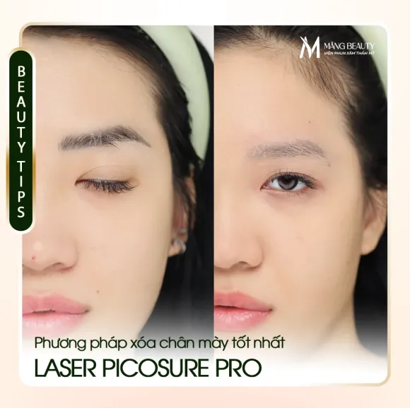 Laser Picosure Pro - Phương Pháp Xóa Chân Mày Tốt Nhất Hiện Nay