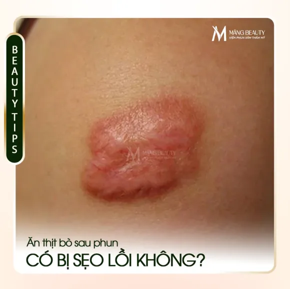 Lỡ ăn thịt bò sau khi phun mày có bị sẹo lồi không? Giải đáp từ chuyên gia Măng Beauty