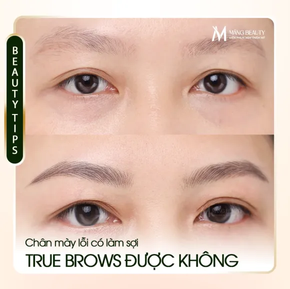 Phun Mày Sợi True Brows Lên Chân Mày Lỗi? Phải Xử Lý Nền Trước Bằng Laser Picosure Pro