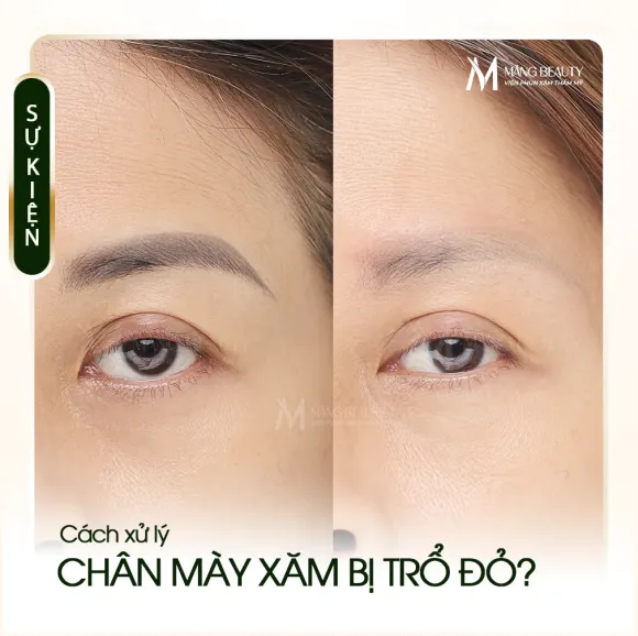 Vì sao chân mày xăm bị trổ đỏ? Cách xử lý an toàn hiệu quả