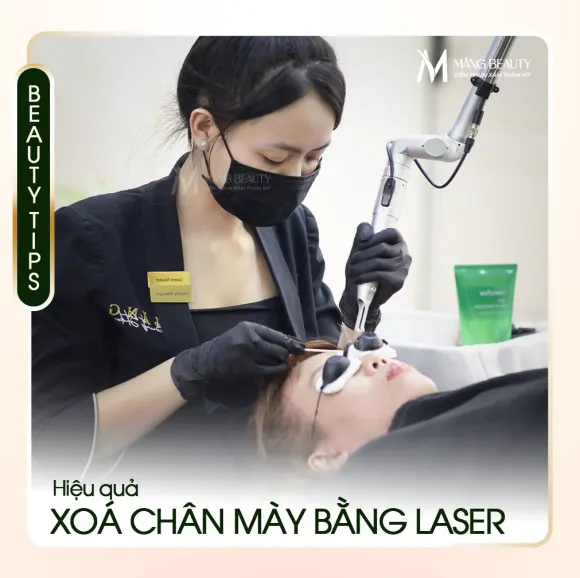 Xóa chân mày bằng laser có hết không? Bao lâu thì làm lại được?