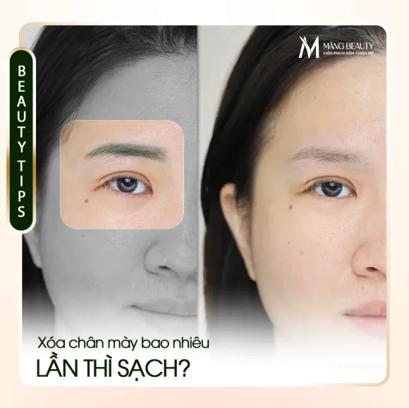 Xóa chân mày bao nhiêu lần thì sạch? Măng Beauty sẽ giúp bạn giải đáp