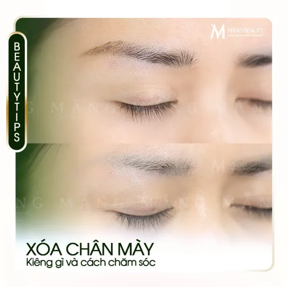 Xóa chân mày cần kiêng gì? Cách chăm sóc và vệ sinh để không bị sẹo