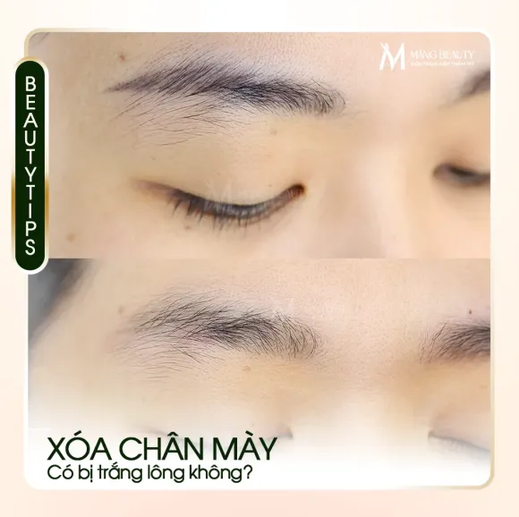 Xóa chân mày có bị ảnh hưởng gì không? Có bị rụng/trắng lông không và bao lâu thì làm lại được?