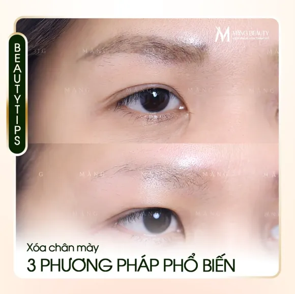 Xoá xăm chân mày có hết không? Top 3 phương pháp xoá chân mày phổ biến hiện nay