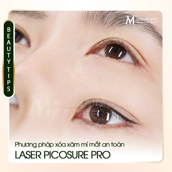 Xóa xăm mí mắt bằng Laser PicoSure Pro - Phương pháp an toàn và tối ưu nhất hiện nay!